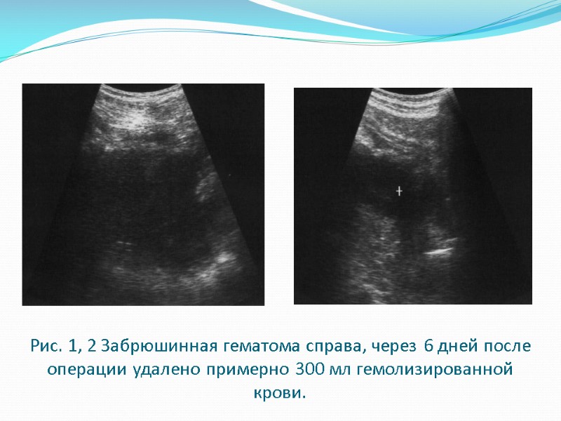 Рис. 1, 2 Забрюшинная гематома справа, через 6 дней после операции удалено примерно 300